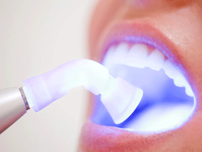 Soft tissue dental laser in Henderson, NV at Smiles by Goh